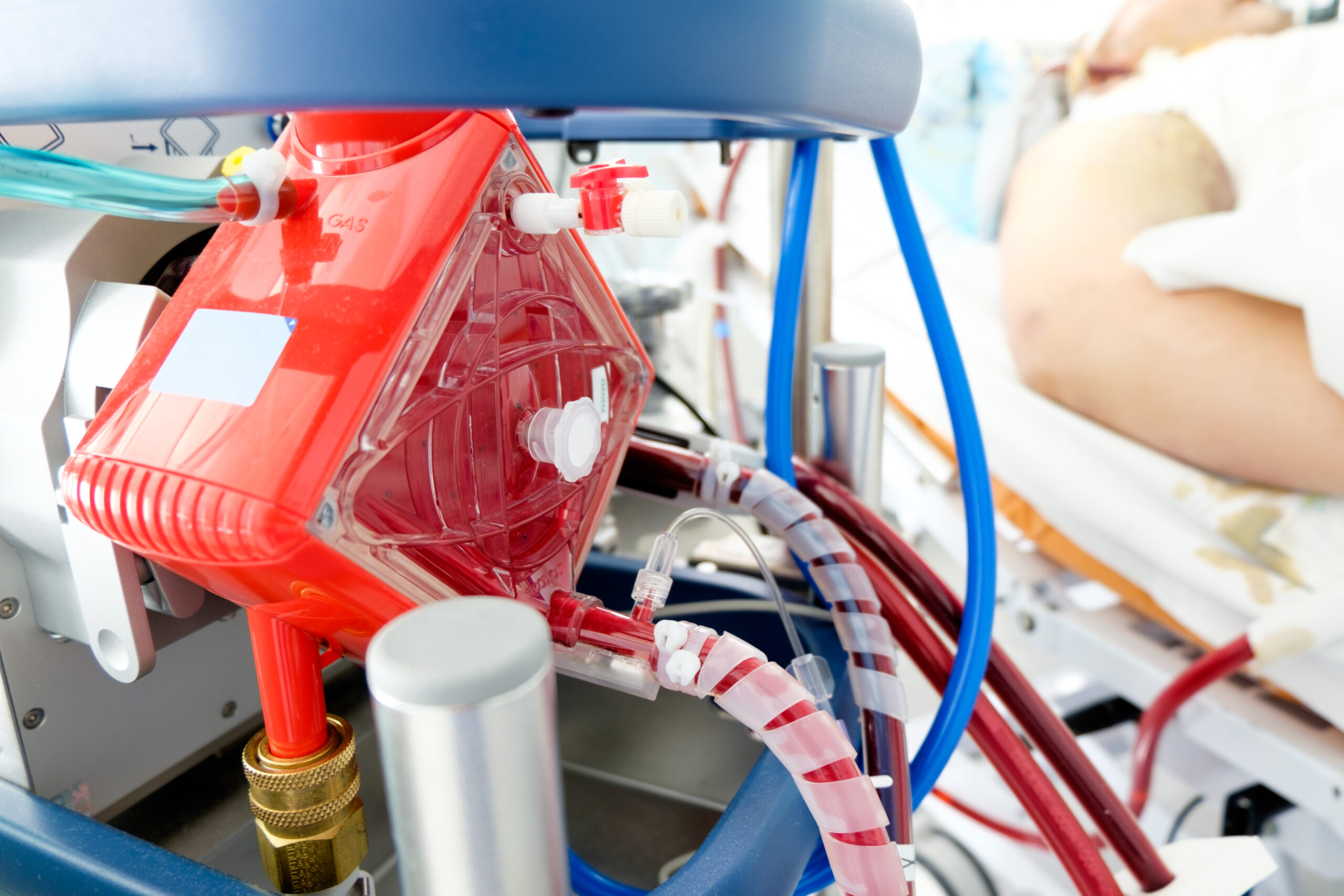 Pros and Cons of Extracorporeal Cardiopulmonary Resuscitation (ECPR)